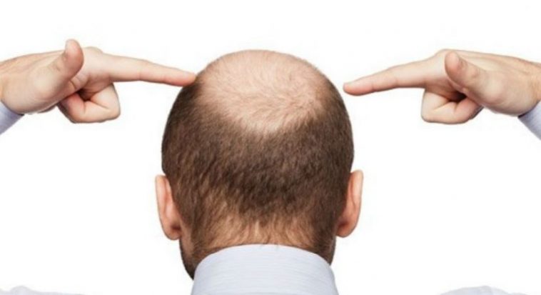 Shkencëtarët aksidentalisht e gjejnë ilaçin gjenetik për rënien e flokëve