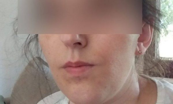 Vajza nga Istogu ka nevojë për ndihmën tuaj, i nevojiten 12 mijë euro për mjekim të syrit