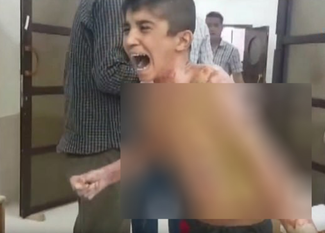 Pamje të tmerrshme të fëmijëve të djegur në Siri, Turqia dyshohet se po përdor armë kimike