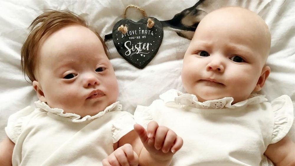 Rasti i rrallë i binjakeve – Si e shpjegojnë mjekët që njëra vajzë lindi me sindromën Down