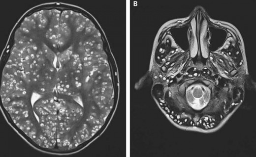 Pikat e çuditshme në imazhin e trurit zbuluan diagnozën e tmerrshme