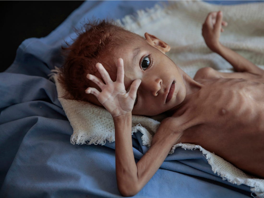“Njerëzit po vdesin urie në Jemen” OBSH jep alarmin