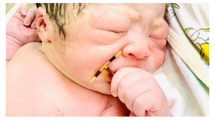 Mrekulli: Foshnja lind me spiralen në dorë, nëna e kishte vendosur kundër shtatzënisë