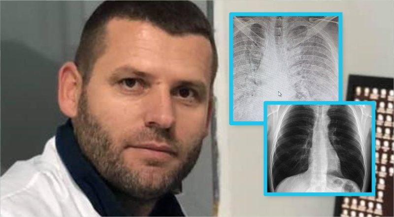 Doktori kosovar publikon pamjet se si koronavirusi i ka dëmtuar mushkëritë 30 vjeçarit