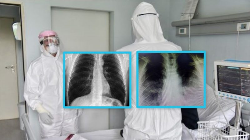 Doktori kosovar publikon fotografitë e rëntgenit: Kështu i dëmton COVID-19 mushkëritë